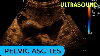 Pelvic ascites due to dilated cardiomyopathy on Ultrasound [upl. by Hylton849]