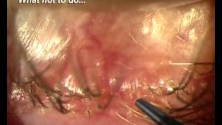 Demodex Blepharitis Is it for real [upl. by Aihcats]