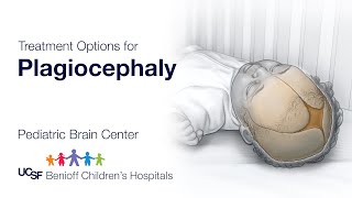 Treatment Options for Plagiocephaly  UCSF Pediatric Brain Center [upl. by Myrt]