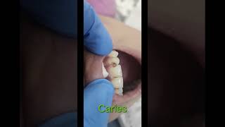 Caries teeth treatment done with finishing and polishingdentist toothdental cosmeticdentistry [upl. by Richie]