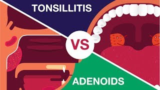 What is Adenoids and Tonsillitis Complete Video [upl. by Nayek275]