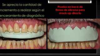 reconstrucciones anteriores con resinas y pins dentinarios [upl. by Rebane554]