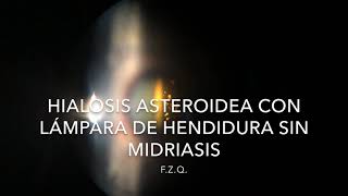 Hialosis asteroidea con lámpara de hendidura sin midriasis [upl. by Nihcas166]