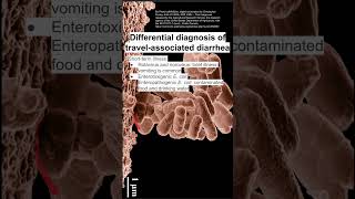 Differential diagnosis of travelassociated diarrhea [upl. by Mali]