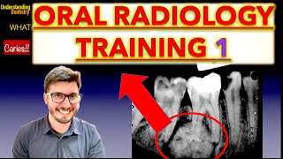 Radiographs Lesion Training Mixed Lesions Periapical X Ray and OPG interpretation dental students [upl. by Rezal315]