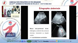 Session doncologie pédiatriqueLes tumeurs abdominales modes de révélation Pr S Benmiloud [upl. by Nereil91]