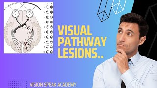 Visual Field Defects Due To Visual Pathway Lesions [upl. by Massey]