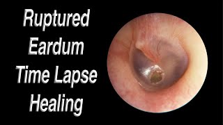 Ruptured Eardrum Healing Closed Time Lapse  A Hole in Eardrum Usually Heals Closed on Its Own [upl. by Emmi]