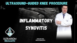 UltrasoundGuided Procedure in Knee Inflammatory Synovitis [upl. by Bondie]