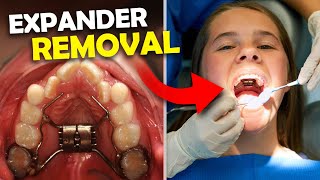 Getting Palatal Expander OFF… What happens when you get your Expander Off  McKinney Orthodontist [upl. by Akimal240]