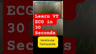 Ventricular tachycardia ecg amp treatment cardiology in 30 seconds [upl. by Hplodur704]