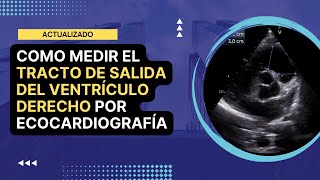 🏅Cómo medir el TRACTO DE SALIDA DEL VENTRÍCULO DERECHO TSVD por ecocardiografía Actualizado [upl. by Nevar]