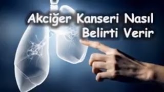 Akciğer Kanseri Nasıl Belirti Verir [upl. by Pepin]