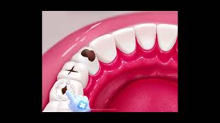 Ultimate Guide to Teeth Cavity Treatment  BeautyByte Animations [upl. by Wernher503]