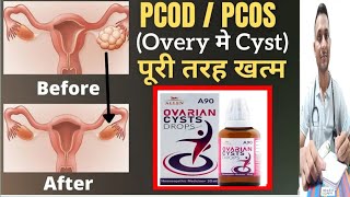 Ovarian cyst  ओवरी में गांठ  PCOD  without operation homeopathic dwaAllen A90 Ovarian Cysts Drop [upl. by Modesty128]