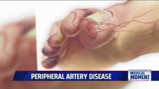 Symptoms and Treatments for Peripheral Artery Disease PAD [upl. by Ennirak774]