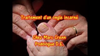 Traitement dun ongle incarné chez un podologue Marc Crenn DE 12 mars 2019 [upl. by Gneh]