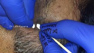 BLACKHEADS REMOVAL AROUND THE EYES PART2 BY POPPING KING DRLALIT KASANA [upl. by Aleac]