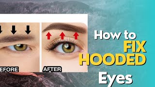 Hooded eyes  droopy eyelid  aging eyes [upl. by Karlin913]