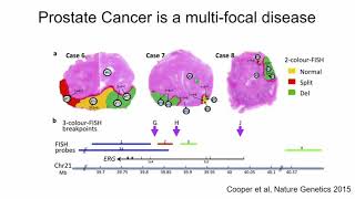 E011 Genome sequencing in prostate cancer [upl. by Enuj]