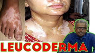 Leucoderma Treatment in Homeopathy by Dr PS Tiwari [upl. by Natan]