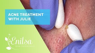 Acne Treatment amp Extractions on Julie  New Patient [upl. by Sellma]