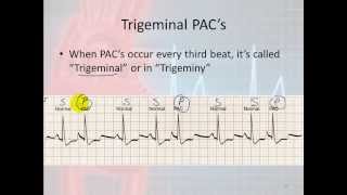 Basic Electrophysiology part 7  Atrial Rhythms part 1 Introduction and PACs [upl. by Sublett]