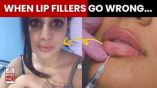 Kylie Jenner Khushi Kapoor amp Urfi Javed What to do when your lip fillers go wrong [upl. by Zildjian63]