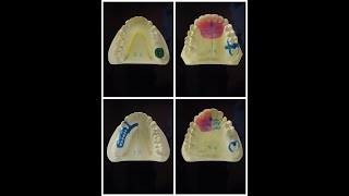 국소 Surveyed Crown 납형ㆍ123YG Dental Lab [upl. by Eniamurt858]