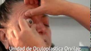 Prótesis Oculares Ergonómicas [upl. by Kancler]