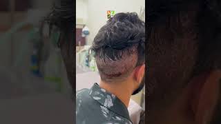 FUE hair transplant l Root Clinic l Hair Transplant shorts [upl. by Mazurek]