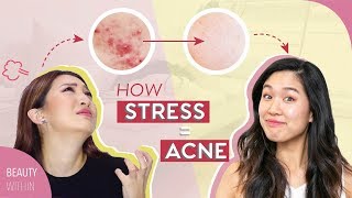 5 Signs  5 Easy Cures to Prevent ACNE and STRESSED Skin [upl. by Kubetz]