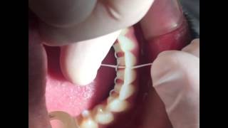 Fio dental  Contenção ortodôntica fixa [upl. by Ahseele]