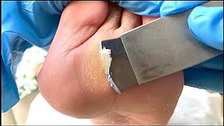 Callus removal from feetampFoot scraping dead skin【Xiao Yan pedicure】 [upl. by Ellehcim]