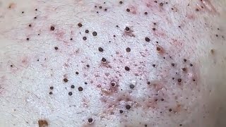 Blackheads amp Whiteheads Satisfying Removal 0027 [upl. by Smailliw]