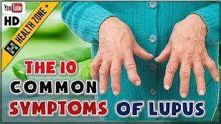 The 10 Common Symptoms of Lupus [upl. by Kezer]