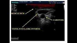 ABORD VEINEUX CENTRAL SOUS ECHOGUIDAGE PAR LE DR BOUARROUDJ NOREDDINE [upl. by Nashbar]