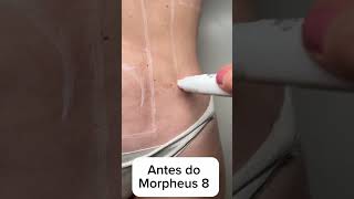 Tratamentos Avançados com Morpheus 8 [upl. by Fredrika]