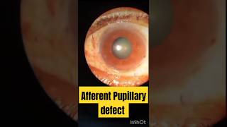 Afferent Pupillary Defect  APD pupilteacher eyediseases [upl. by Anirtik55]