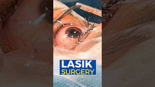 Live Lasik Surgery [upl. by Belshin]