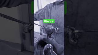 uterus fibroiduterus uterustransplant retroverteduterus shortsfeed shortvideo [upl. by Romonda]