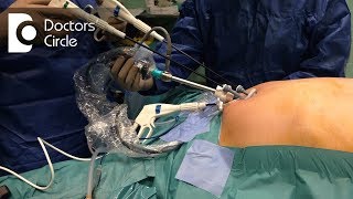 How long does it take to recover from Laparoscopic Surgery  Dr Beena Jeysingh [upl. by Florence334]