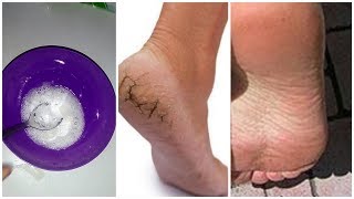 HOW TO REMOVE DEAD SKIN CELLS FROM YOUR FEET IN MINUTES  Foot Care Routine TRY this magical remedy [upl. by Negriv]