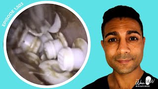 1503  TOP 10 MOST BIZARRE FOREIGN BODY EAR EXTRACTIONS 🫣 [upl. by Annirac641]