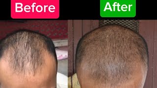 Mene jhut kaha ki naye baal agaye hai😢 Lets regrow hair naturally [upl. by Ttoile]