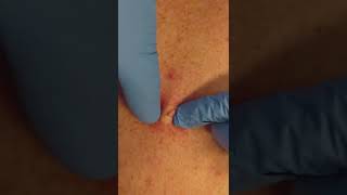 Sebaceous cyst extraction by a dermatologist shorts pimplepopping  CONTOUR DERMATOLOGY [upl. by Ilbert]