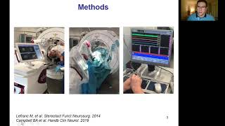 MRIgLITT thalamotomy for essential tremor  ESSFN 2021 [upl. by Leciram]