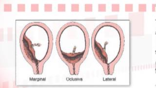 Dr Ignacio Pérez Tomasone ¿Qué es la placenta previa [upl. by Enelyaj670]