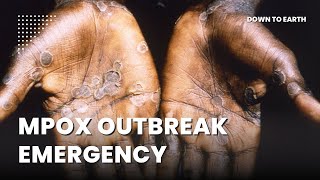 WHO terms latest upsurge of mpox ‘extraordinary’ [upl. by Hollie256]