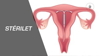 Stérilet  avantages et inconvénients  Gynécologie [upl. by Wilfred]